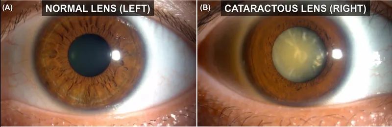 Normal clear lens versus cataractous lens — hard cataract evaluation and phaco surgery planning at Madhavi Netralaya, Ara, Bihar
